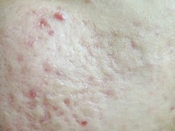 Acne scar-before